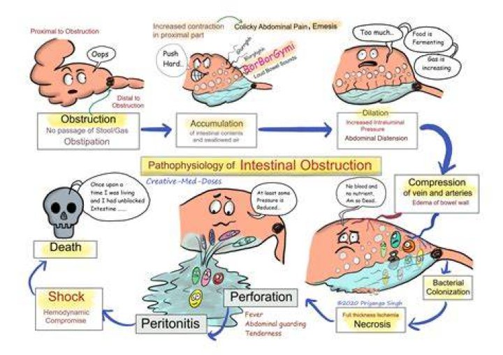 Can a bowel blockage cause sepsis?