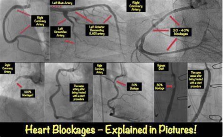 Can a heart CT scan detect blocked arteries?