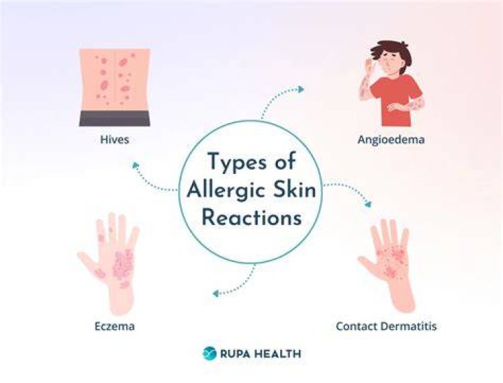 Can a person be allergic to alginate?