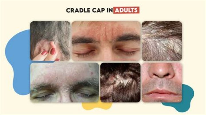 Can I just leave cradle cap alone?