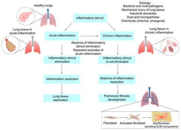 Can pulmonary fibrosis be misdiagnosed?