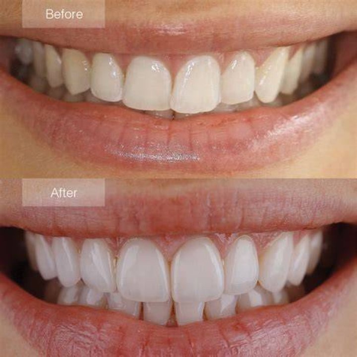 Can you whiten a veneer tooth?