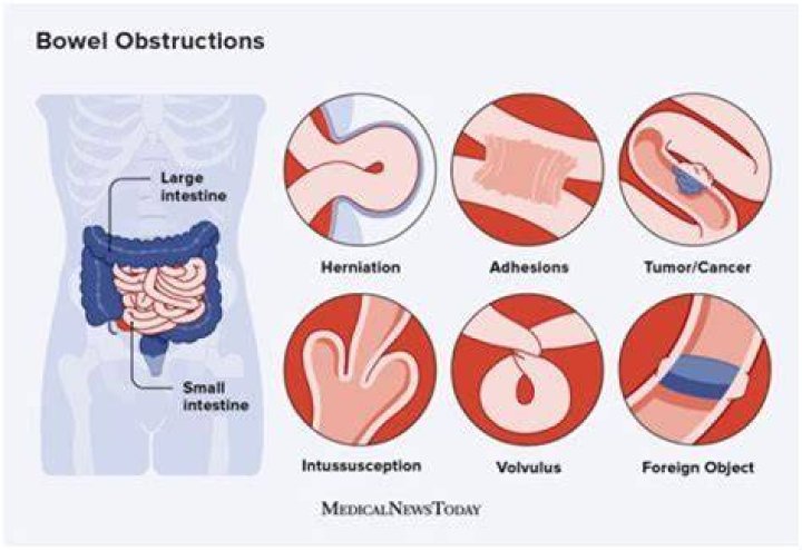 How do you know if you have a partial bowel obstruction?