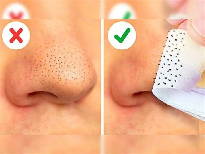 How do you remove a deep blackhead?