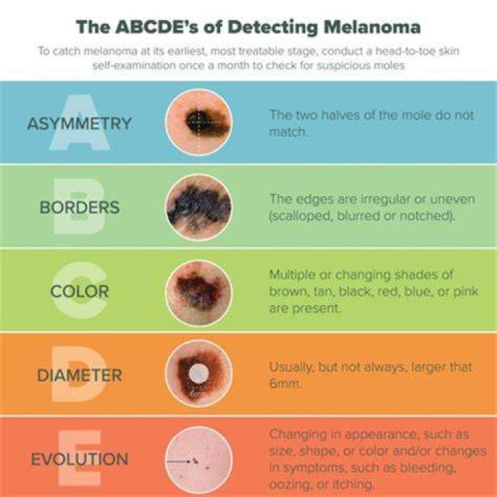 How often do dermatologists miss melanoma?