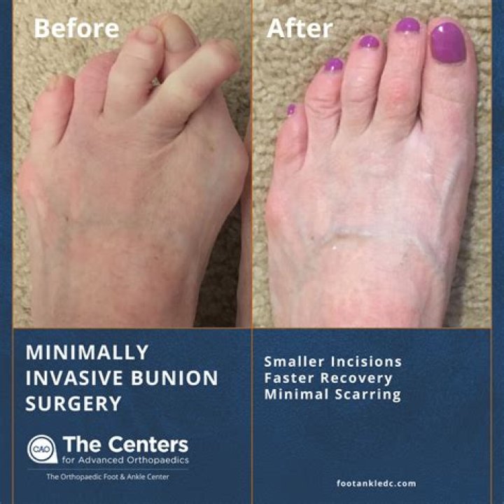 Is bunion surgery worth having?