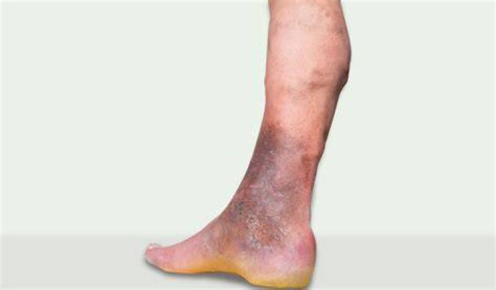 What cold legs mean?