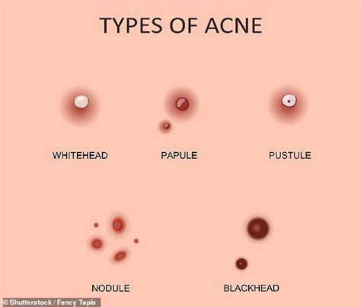 What is that hard white core in a pimple?