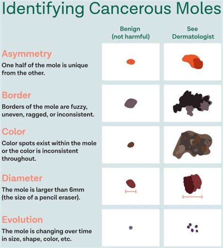 What type of moles are cancerous?