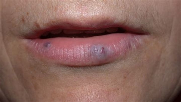 Why is there a black spot on my inner lip?